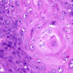 Squamous Cell Carcinoma of the Bladder