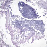 Lipoblastoma